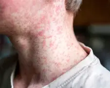 Nuevos casos de sarampión en Argentina y alerta sanitaria nacional.